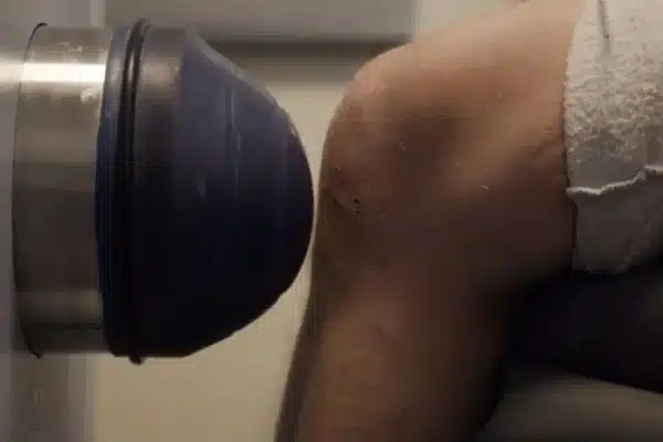 Treating Arthritis Without Leading to Surgery