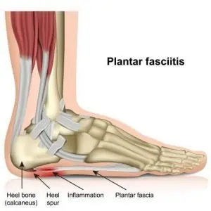 plantar fascia is a long flat ligament on the bottom of your foot