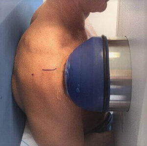Shoulder Tendonitis Treatments Alternative to Surgery