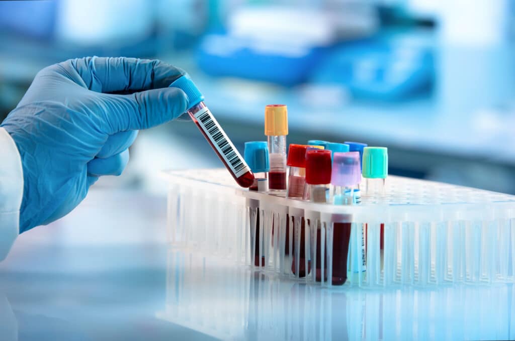 Doctor's hand, taking a blood sample tube from a rack.