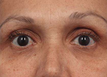 Emface_PIC_Ba-card-female-eyes-172_ENUS100_after__FocusFillMaxWyIwLjAwIiwiMC4wMCIsNDYwLDMzMF0