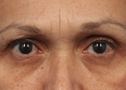 Emface_PIC_Ba-card-female-eyes-172_ENUS100_before__FocusFillMaxWyIwLjAwIiwiMC4wMCIsNDYwLDMzMF0