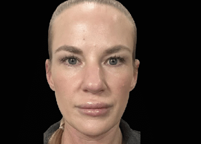 Emface_PIC_Ba-card-female-face-097_ENUS100-AFTER-Emface