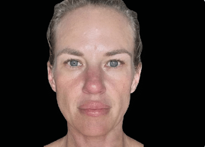 Emface_PIC_Ba-card-female-face-097_ENUS100-BEFORE-Emface