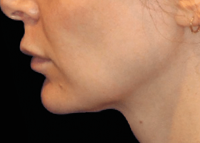 Emface_PIC_Ba-card-female-submentum-cheek-123_ENUS100-AFTER-Emface